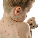 Child with red spots on back holding a teddy bear