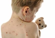 Measles Deaths Open New Fight Over Facts Child with red spots on back holding a teddy bear
