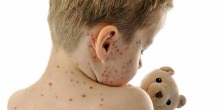 Child with red spots on back holding a teddy bear